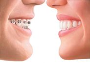  Ortodonzia linguale